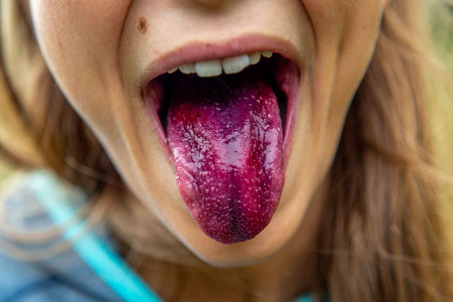 person sticking out their tongue which is reddish purple